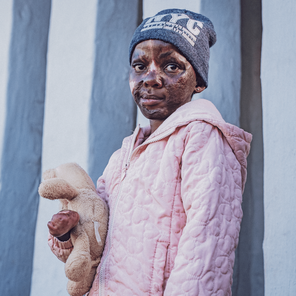 The Lucky Ones - Helping Burn Victim Survivors In South Africa